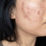 The Role of Dermatology in Managing Acne Scars