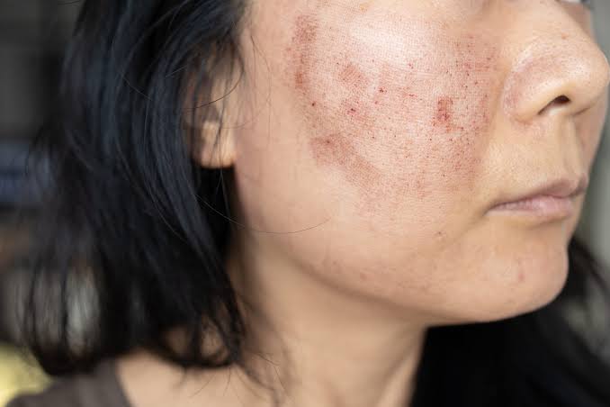 The Role of Dermatology in Managing Acne Scars