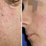 The Role of Dermatology in Treating Acne and Other Skin Conditions