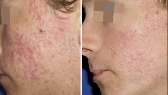 The Role of Dermatology in Treating Acne and Other Skin Conditions
