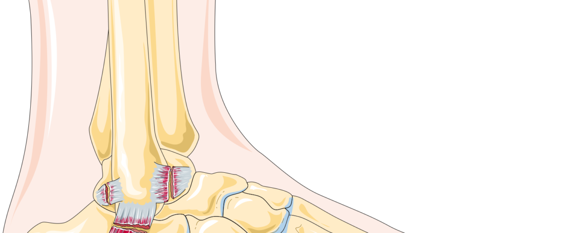 Understanding the Different Grades of Ankle Sprains