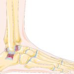 Understanding the Different Grades of Ankle Sprains