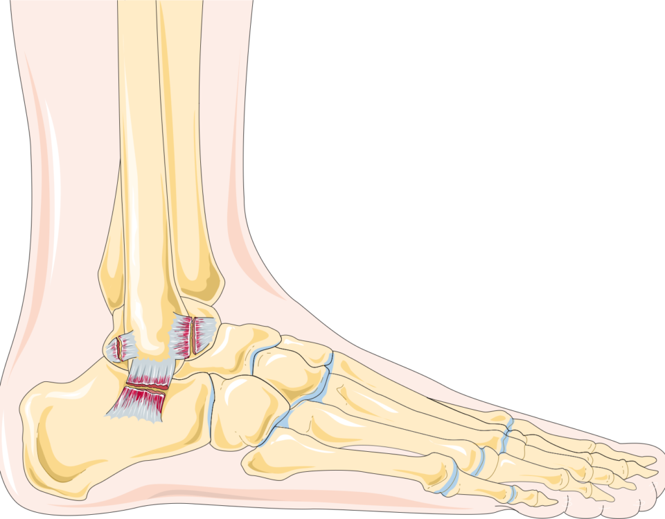 Understanding the Different Grades of Ankle Sprains