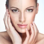 Exploring the Different Types of Laser Treatments for Skin Rejuvenation
