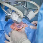 Understanding the Benefits and Risks of Cataract Surgery
